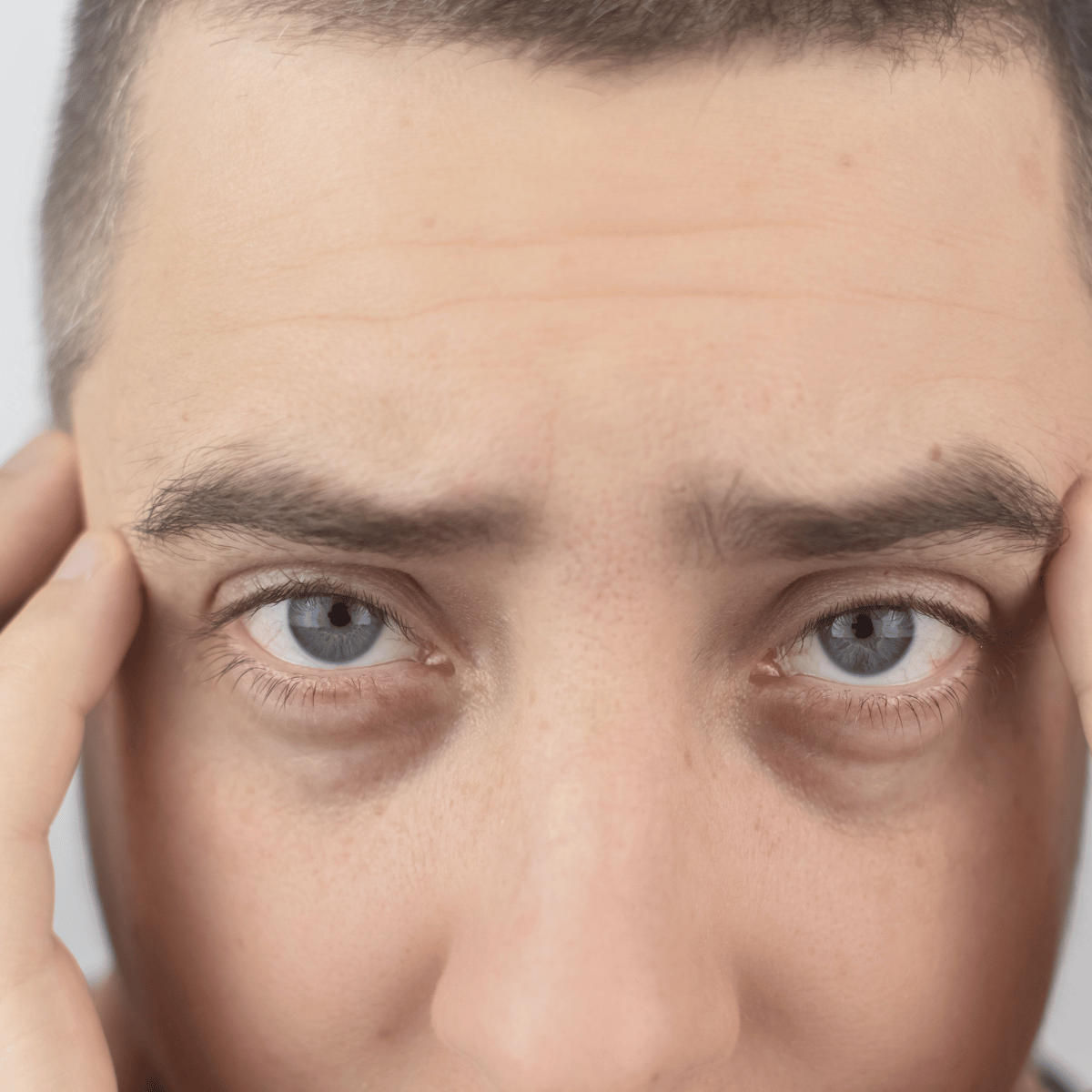 Geschwollenes Auge und geschwollenes Augenlid Mann mit geschwollenem Auge und geschwollenem Augenlid blickt nach vorne und hält die Hände an die Schläfen.