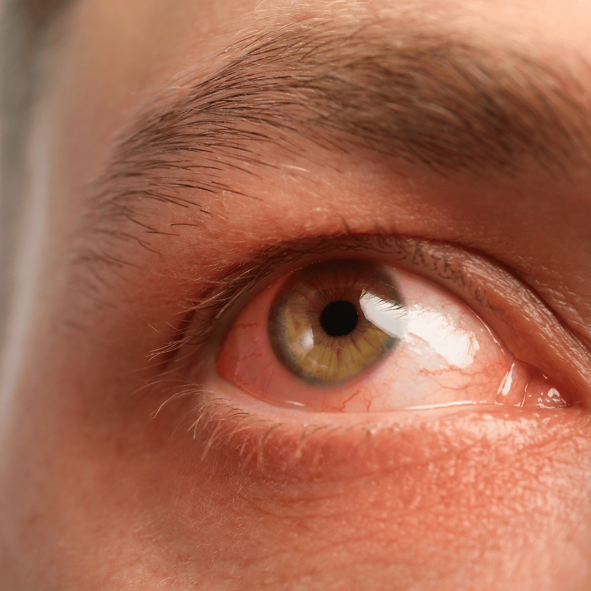 Rotes Auge mit sichtbarer Bindehautrötung | Augenarzt Graz Dr. Ewald Lindner Gerötetes Auge mit sichtbarer Rötung der Bindehaut als mögliches Symptom einer Bindehautentzündung oder Augenreizung.